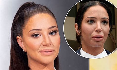 Tulisa Suffered An Allergic Reaction To Lip Fillers As Her Pout Is