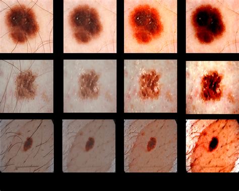 Example Images Of The Skin Cancer Regions Before And After Image