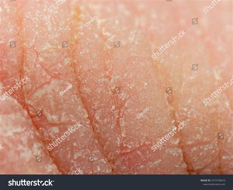 Close Shot Dry Skin On Knuckles Stock Photo 1919730923 Shutterstock