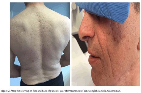 Clinical Experimental Dermatology Atrophic Scarring