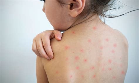 Measles What You Need To Know Nih Medlineplus Magazine