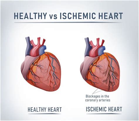 Ischemic Heart Disease Surgery In India Cost Hospitals And Doctor