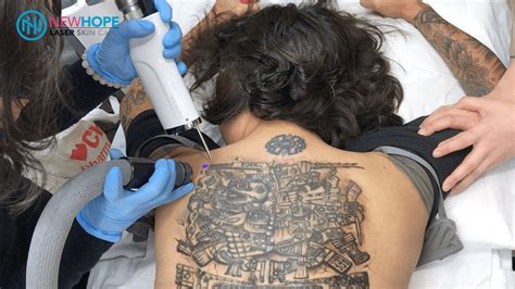 Aggregate Black Tattoo Laser Removal In Coedo Com Vn