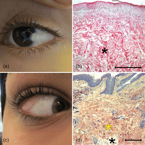A A 13 Year Old Child With A Limbal Dermoid B Histological Picture Of