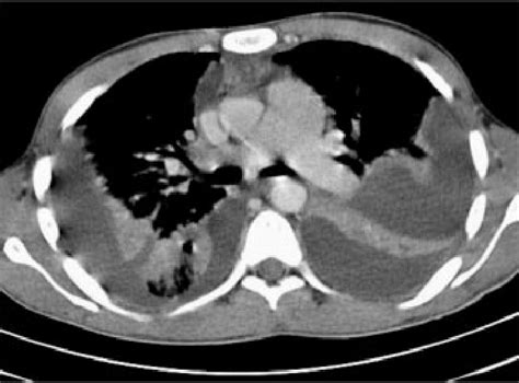 Contrast Enhanced Ct Scan Of The Thorax Shows Large Bilateral Pleural
