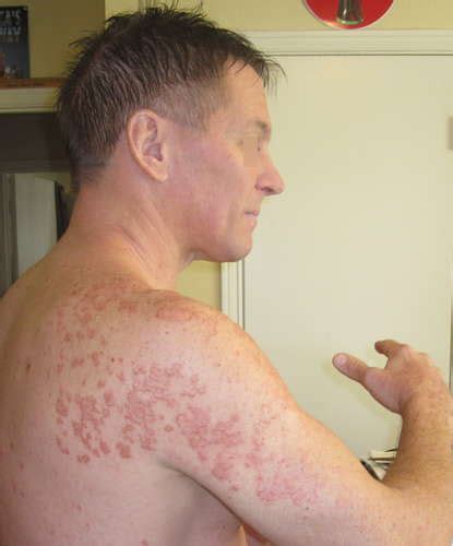 Hepatitis Skin Rash Pictures