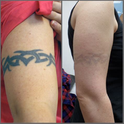 Laser Tattoo Removal Mystique Medical Day Spa