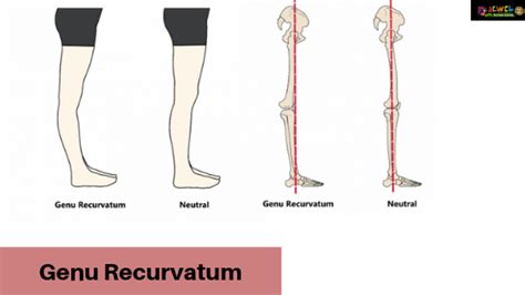 Genu Recurvatum Type And Causes Of Genu Recurvatum
