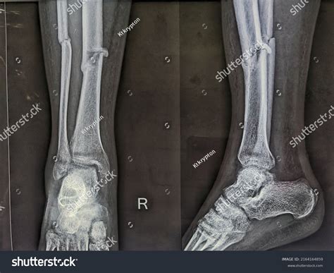 Xray Showing Malunited Fracture Both Bones Stock Photo 2164164859