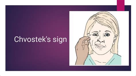 Chvosteks Sign Test For Hypocalcemia Clinical Sign Learning