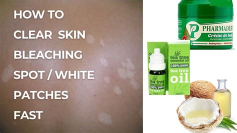 How To Clear White Patches Bleaching Spot Cream Reactions White