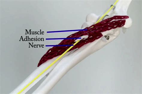 What Is Peripheral Nerve Entrapment
