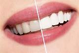 How Many Teeth Whitening Treatments Do I Need Photos