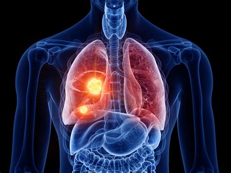 Lung Cancer Symptoms Causes And Treatment Of Lung Can Vrogue Co