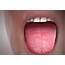 Painful Dry Mouth  General Center SteadyHealthcom