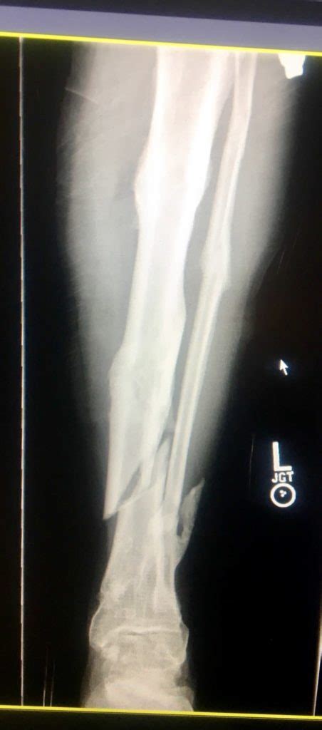 Tibia Fracture In Athletes Howard J Luks Md