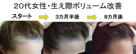 100+ EPIC Best M 字はげ 前髪 女 - 今日は楽しかった