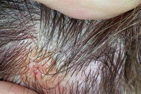 Scabs And Sores On Scalp 17 Causes Pictures And Treatment