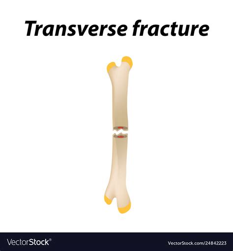 Transverse Bone Fracture Infographics Royalty Free Vector
