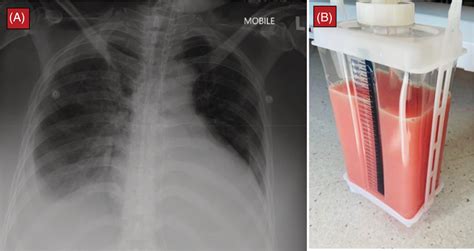 Pink Chylothorax A Chest X‐ray Showed Cardiomegaly And Bilateral