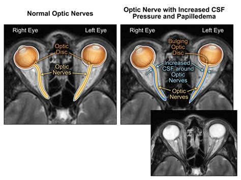 Panel 4 Optic Nerve Comparison
