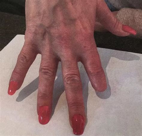 Gran Forced To Have Finger Amputated After Nail Technician Slips While Doing Manicure Mirror
