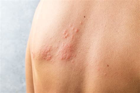 Treating Shingles With Herbs And Diet Mcdowell S Herbal Treatments