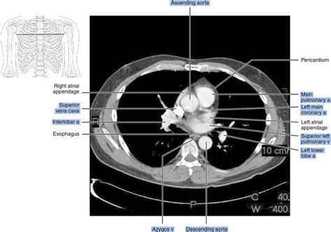 CT Of The Thorax Radiology Key