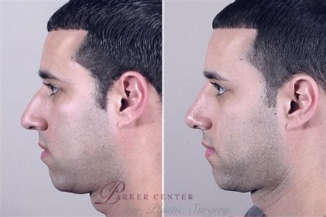Rhinoplasty Before And After Pictures Case 952 Paramus Nj Parker