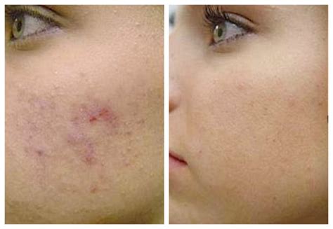 Retinol For Acne Scars Benefits Of Retinol To Help With Acne Shine