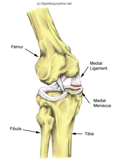 Medial Mensicus Tear Knee Pain Help And Healing Pinterest Knee