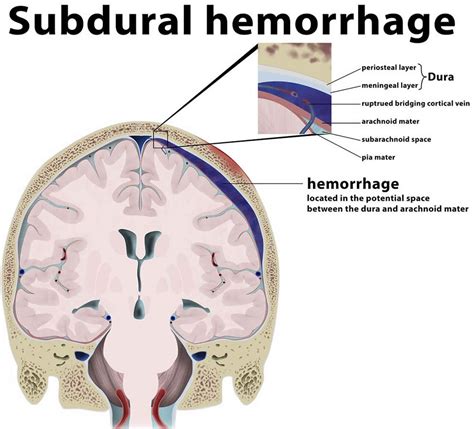 Subdural Hematoma Types Symptoms Causes Treatment Diagnosis My Xxx Hot Girl
