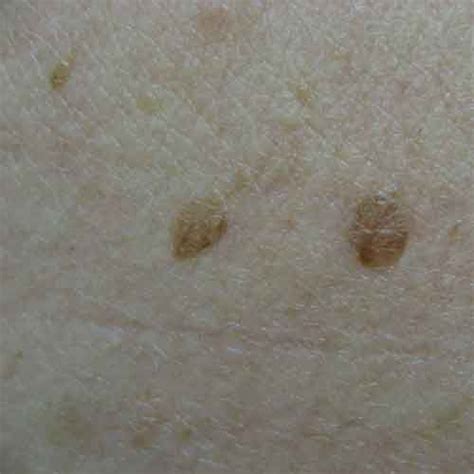 Find Out What Benign Moles Look Like