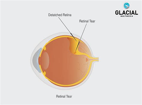 Retinal tears are relatively common. Retina Sarasota | Retinal Tear Sarasota | Palm Coast Eye