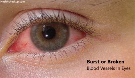 Burst Or Broken Blood Vessels In Eyes Causes Symptoms Treatment