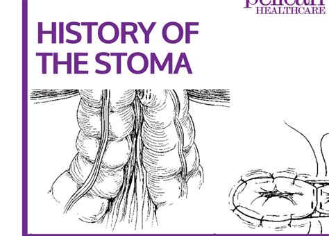 Stoma History Archives Pelican Healthcare