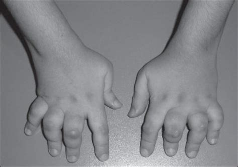 Juvenile Idiopathic Arthritis Jia Signs Subtypes Cause Diagnosis