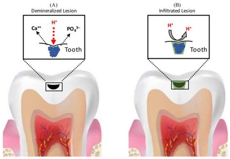 Minimally Invasive Therapies For The Dental Caries Encyclopedia Mdpi