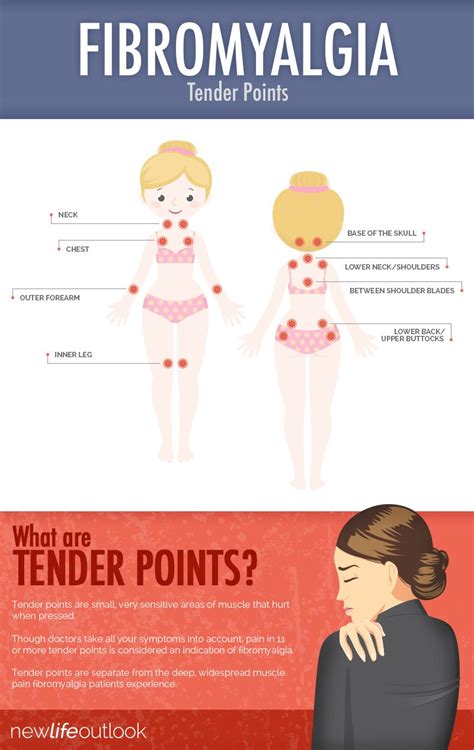 Fibromyalgia Tender Points Diagram Fibromyalgia Tenders Polymyalgia Rheumatica
