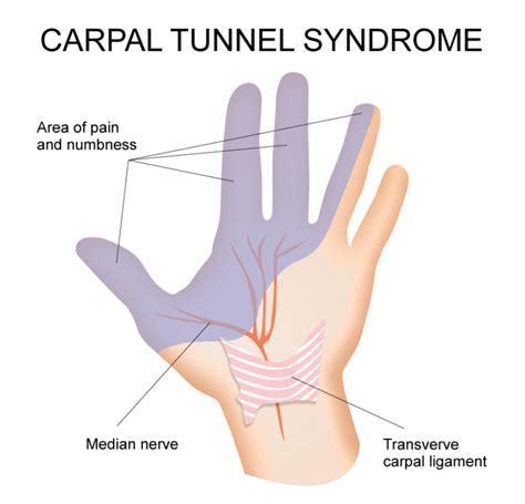 Carpal Tunnel Syndrome Hand Therapy Group