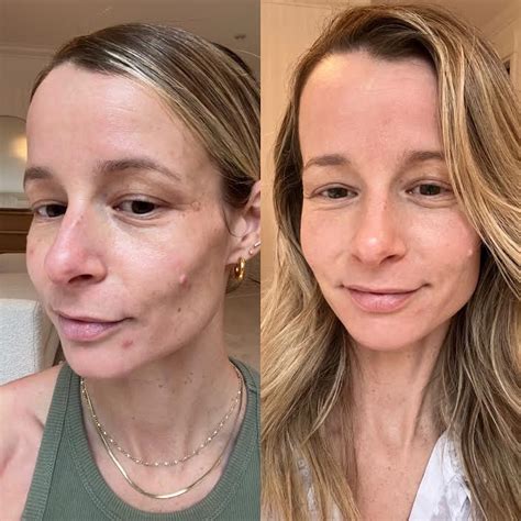 My Experience With The Halo Laser Treatment Raw Beauty Talks