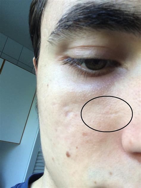 What Are These Lines On My Face Skincareaddiction