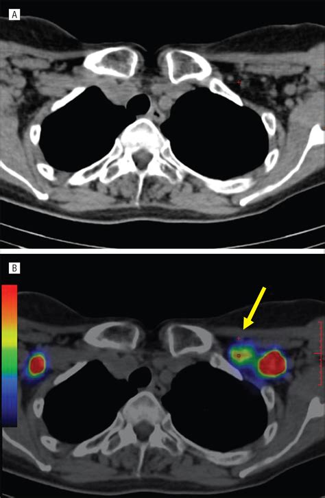 Supraclavicular Swollen Lymph Nodes Questaffiliates