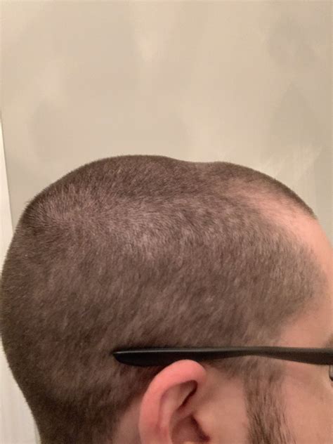 Fun Sources Dent In Back Of Head