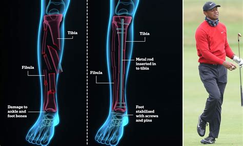 Tiger Woods Leg Injury Mri Tiger Woods Has Non Life Threatening