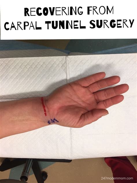 Carpal Tunnel Surgery Recovery 3 Months Later 247 Modern Mom
