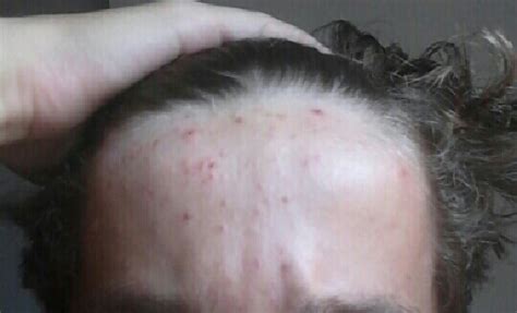 Sudden Forehead Acne With Pictures General Acne Discussion
