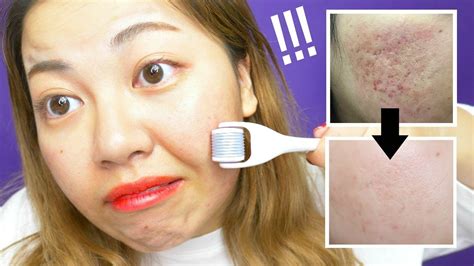 Getting Rid Of Acne Scars By Needling Before After Results Youtube