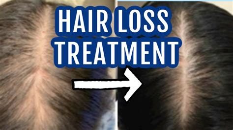 Top Image Does Spironolactone Cause Hair Loss Thptnganamst Edu Vn