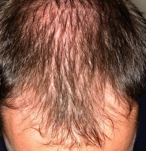Alopecia Androg Nica Qu Es Causas S Ntomas Tratamiento Y Mucho M S